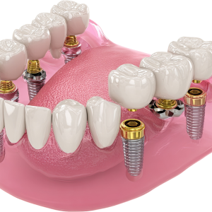 PFM CAP FOR IMPLANTS